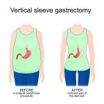 Diet after gastric sleeve