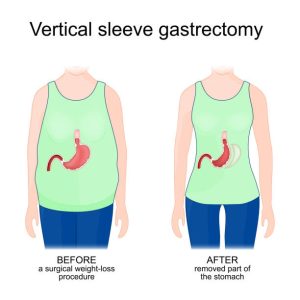 Diet after gastric sleeve